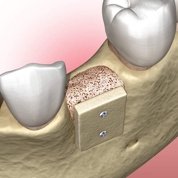 Bone Grafting Albuquerque NM | Cottonwood Oral & Maxillofacial Surgery